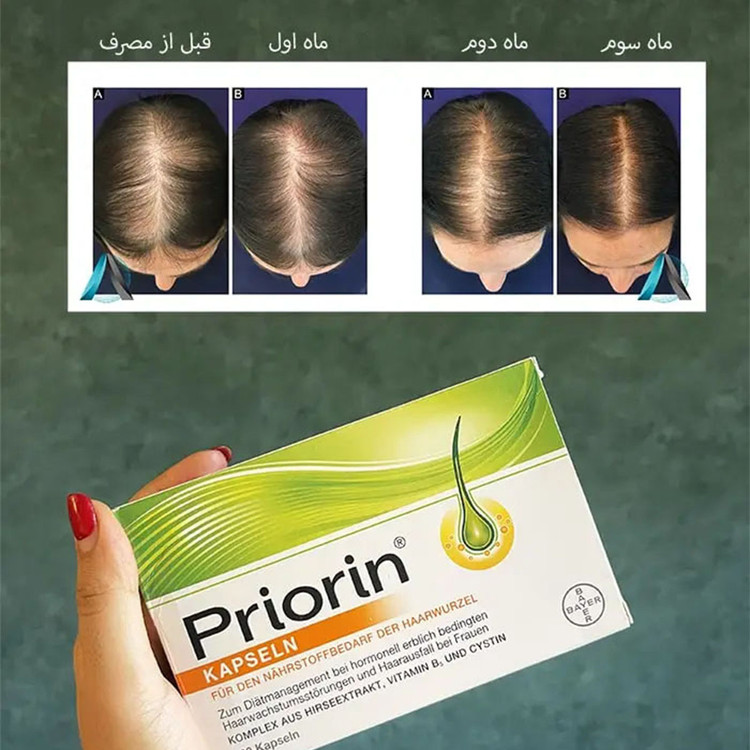 قرص ضد ريزش موی ارثی و هورمونی پریورین ورقه ای 30 عددی اصل آلمان